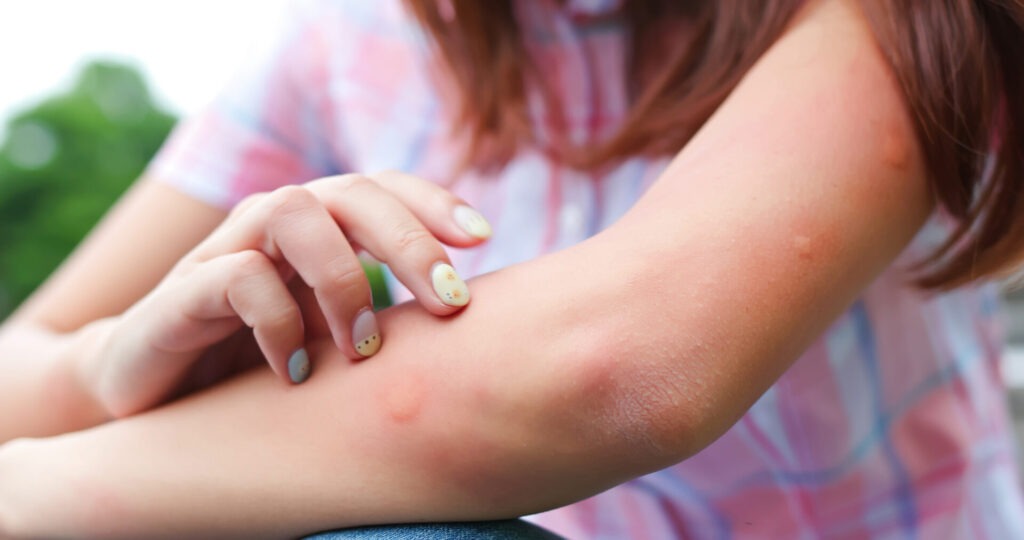 Bitten by mosquito in summer › 스타일리쉬 플레이스 팔에 가려움을 느끼며 긁고 있는 여성의 손. 피부에 붉은 발진이 보이며, 곰팡이와 관련된 알레르기 반응을 암시하는 이미지.